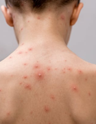 chickenpox img