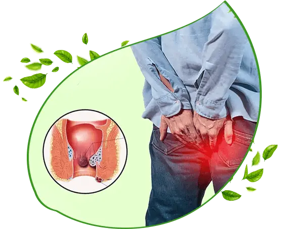 Piles Ayurvedic Treatment