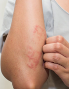 Skin Disorder img